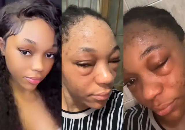 “Na Alcohol Give You Gbas Gbos for Eye” – Reactions As Lady Shares Proof of Alcohol Allergy on Her Face
