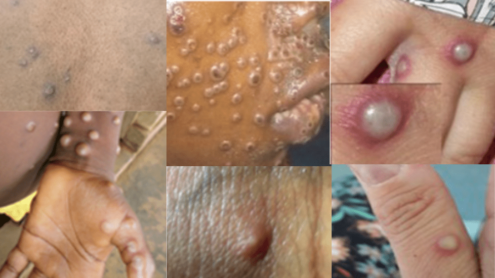 Monkeypox Resurgence Hits Africa